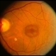 Bull's Eye Maculopathy